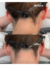 サロンドベルム(Salon de BELME)/ダブル脱毛：before/after