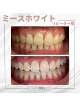 ミースホワイトニング(mys whitening)/ビフォーアフター【歯科提携】