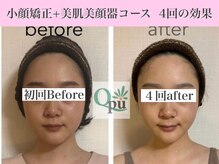 キュープ 表参道店(Qpu)/美顔器モニターコース4回の変化