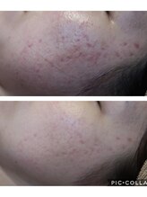 ベビースキン(baby skin)/ニキビ肌改善