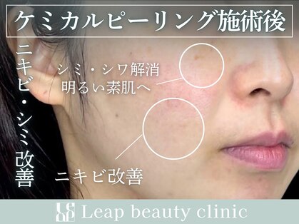 リープ(Leap)の写真