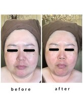 エクレボーテ(ECOULERBEAUTE)/施術例：ハーブピーリング