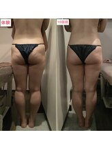 ビタミンスパ 中野店/－3.9ｃｍダウン★施術回数10回