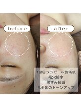 ゼニス 池袋本店(ZENITH)/ざらつく詰まり毛穴も☆