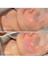 ウィズ(with)/REVIハーブピーリング