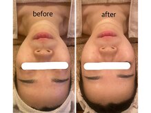 うつくし痩身 美サロン ゼットワン(Z-ONE)/フェイシャル　カーボキシーケア