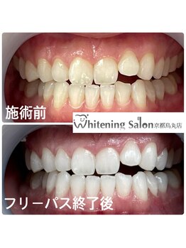 ホワイトニングサロン 京都烏丸店/ホワイトニング施術後