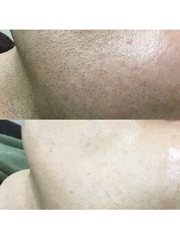 メンズサロンエヌエー(MEN'S SALON NA)/メンズ美肌脱毛!