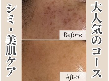 リシェス(Richesse)/長年のシミ悩み・綺麗な肌に