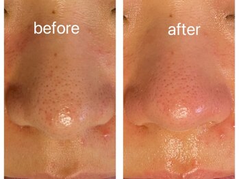 オゾンレメディ(O3remedy)/毛穴洗浄