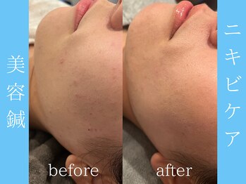 ビープラス(BEE PLUS)/頬ニキビケア