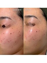 エステティックサロン ナチュラーレ/ニキビ・表面の凸凹