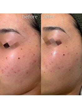 エステティックサロン ナチュラーレ/ニキビ・表面の凸凹