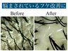 【フケ/痒み改善】黒い服も怖くない。【20%】ヒト幹細胞ヘッドスパ ¥17600→
