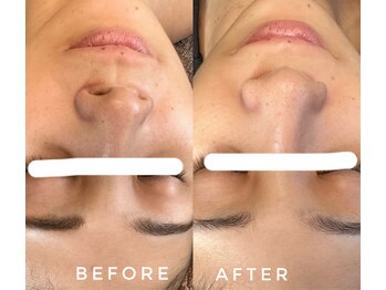 カウニス るる(kaunis)/【ララピール】Before After