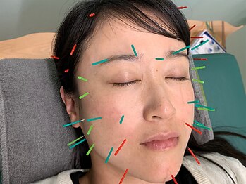 たまプラーザ駅前鍼灸整骨院/美容鍼ライトコース 肌質UP!