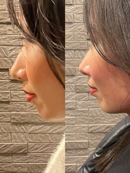 長寿鍼灸院 長寿整骨院/ハリネズミ女優美容鍼効果★