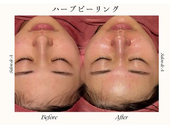 サロンドエー 帝塚山(Salon de A)/ハーブピーリング