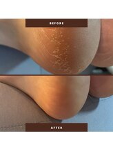 マオヌー(MAONU)/韓国式足裏角質ケア　症例写真