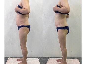 アイリーボーテ 東大阪(アイリーBEAUTE)/痩身