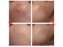 ベビースキン(baby skin)/肌改善