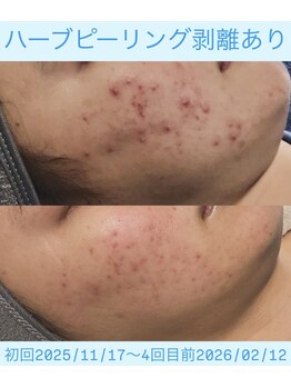 ソアン(Soin)/ハーブピーリング