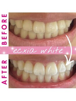 エクシアホワイトニング 稲沢店/お客様ビフォーアフター
