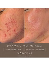 ソアン(Soin)/ニキビ改善