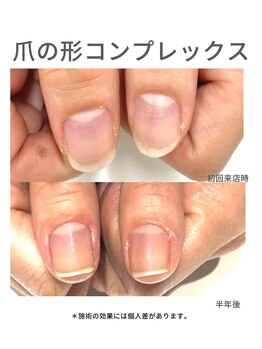 30代/爪の形コンプレックス