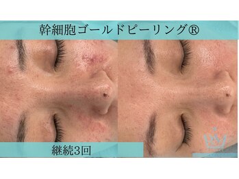 リメイクビューティークリニック(REMAKE BEAUTY CLINIC)/改善しない赤ニキビに