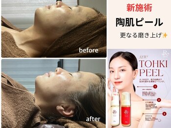 ベリル(BERYL)/《新施術》陶肌ピールで磨き上げ