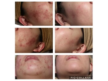 ベビースキン(baby skin)/肌改善