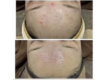 レア(le'a)/おでこプツプツしてませんか？？