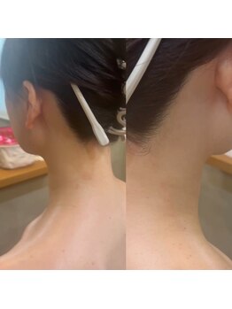 ベラノーブル(bella noble)/結婚式前に魅力的なうなじへ