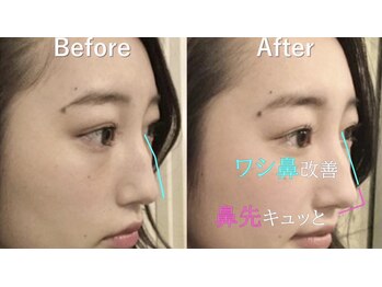 ラプリ 大宮店(Raplit)/隆鼻＋輪郭矯正40分10回