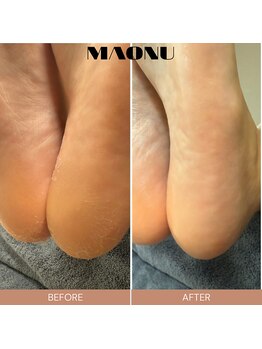 マオヌー(MAONU)/韓国式足裏角質ケア　症例写真