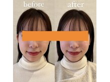 ハリノヒ 本町院/1回の美容鍼施術前後