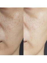 ミレマユメイク(mire)/ゆらぎ肌を整える角質ケア