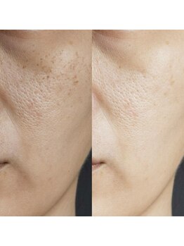 ミレマユメイク(mire)/ゆらぎ肌を整える角質ケア