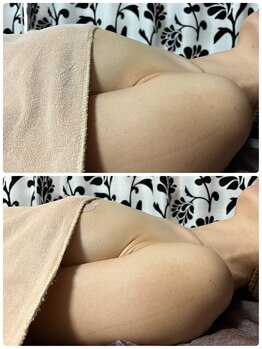 ルミエール(Lumiere)/【倉敷市】バストアップ施術事例