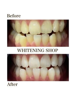 ホワイトニングショップ 下関店/長年の悩み/6～8回照射