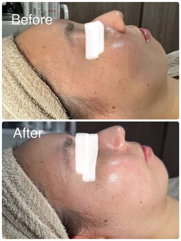 ルミネル 名古屋新栄(Luminelle)/顔脱・毛穴