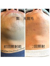 ココリ(CoCoRe)/髭　光脱毛