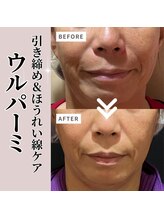 小顔ウナ学芸大学店(UNA)/ウルパーミ☆ビフォアアフター