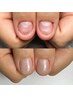 【お爪の白い部分がない、欠損してる方】深爪育成2回目以降