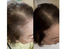 カナエル ビューティーサロン(Canael Beauty salon)/プロセルセラピーズ　5回