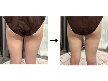 ドクターエイジレス(DR.AGELESS)/脂肪冷却コース1回