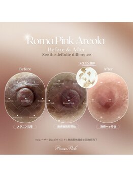 ココノワ(coconoix)/ローマピンク乳輪