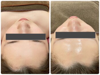 マリスレジーナ 新保店(MarisRegina)/フェイシャル【ララピール】