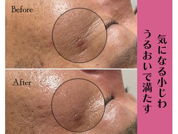 ヴィータ(VITA)/陶肌トリートメント